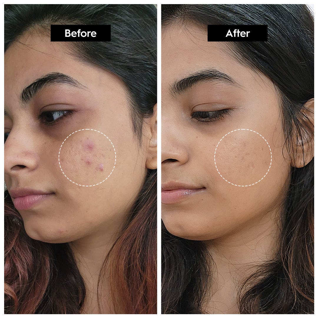 The Ordinary Niacinamide Serum 10% + Zinc 1% Supersize Serum | Best Quality Serum 30ml